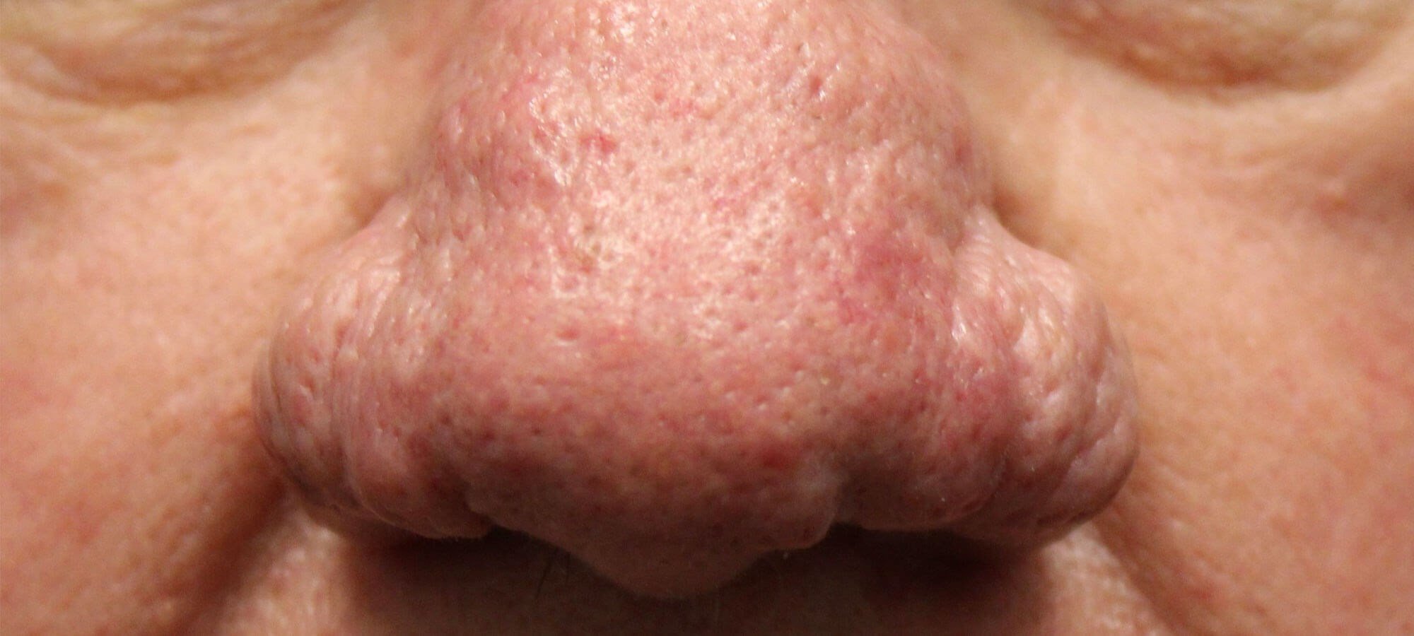rosacea nose bumps